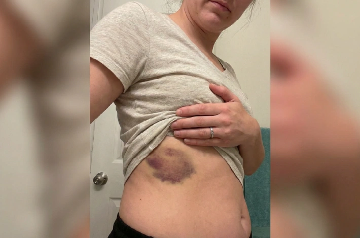 Pele avermelhada após manobra firme de massagem modeladora
